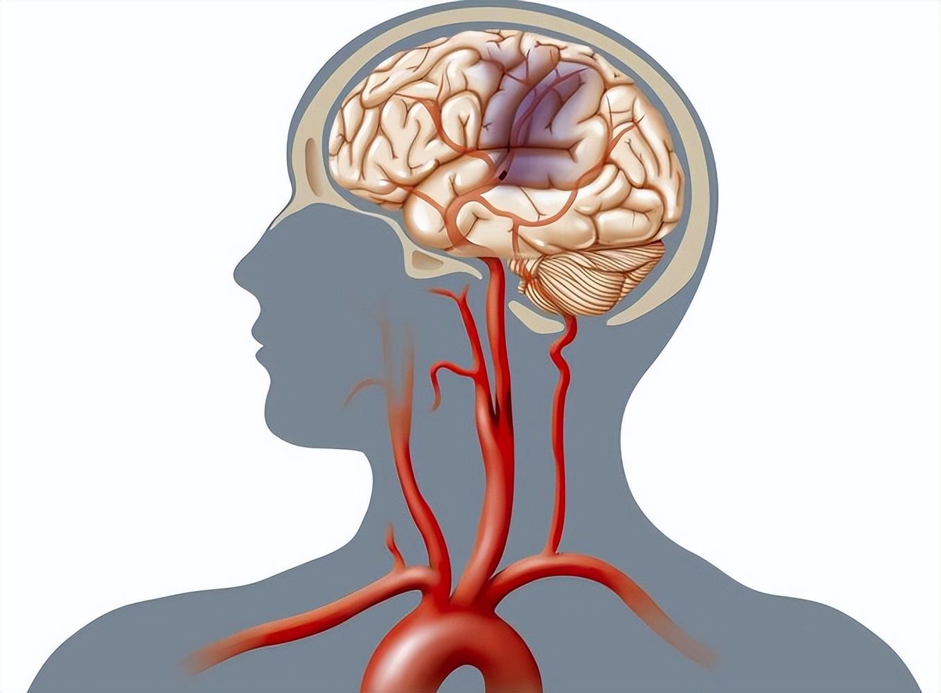 年轻人脑供血不足表现(4大症状提示脑供血不足)