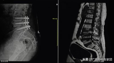 ​椎体压缩性骨折 椎体压缩性骨折是什么？老年人预防得先做好这一点