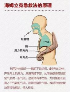 ​海姆立克急救法图解