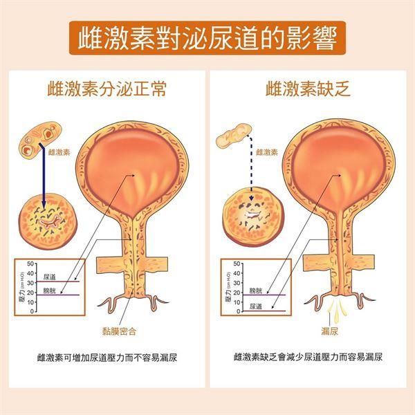 更年期尿失禁怎么办 泌尿道困扰怎么改善