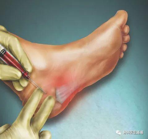 足底筋膜炎？你想知道的、该知道的，都在这