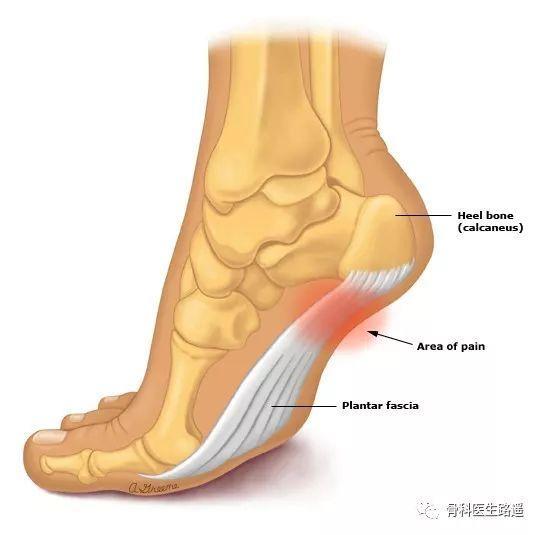 足底筋膜炎？你想知道的、该知道的，都在这